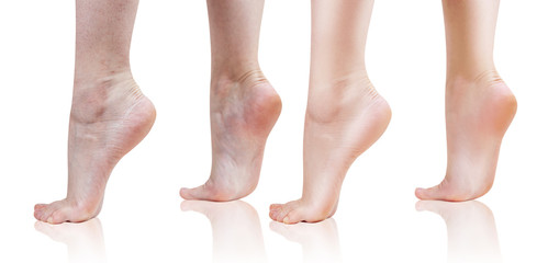 Female feet with dry skin before and after treatment or retouch.