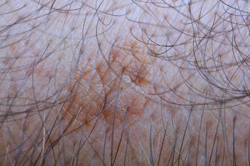 Sample of seborrheic keratosis close up