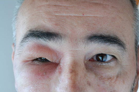 Swollen eye from the sting of the wasp