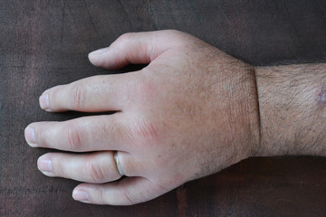 Swollen fist due to the sting of the wasp