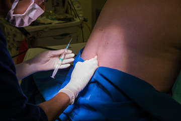 Close up image of a doctor performing a epidural spinal block for a pregnant woman