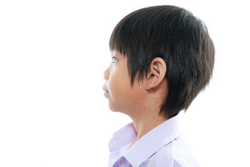 asian boy screatching his neck with rash on white background isolated