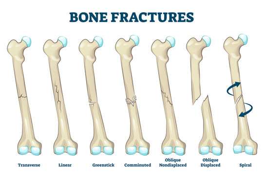 Bone fractures vector illustration