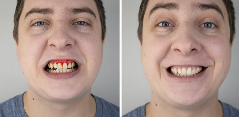 A man has gum bleeding. Photos before and after treatment of periodontitis, gingivitis and bleeding gums. The concept of prevention of oral diseases and treatment by a periodontist - obrazy, fototapety, plakaty