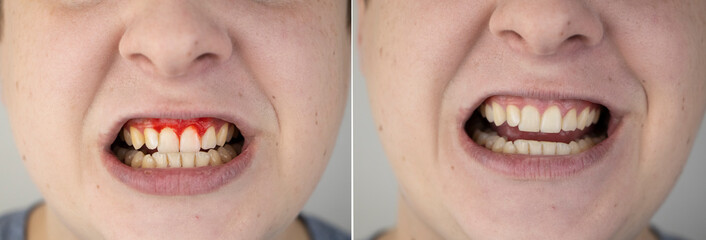 A man has gum bleeding. Photos before and after treatment of periodontitis, gingivitis and bleeding...