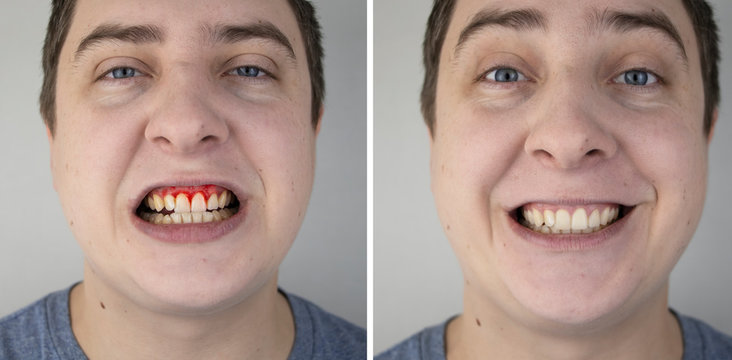 A man has gum bleeding. Photos before and after treatment of periodontitis, gingivitis and bleeding gums. The concept of prevention of oral diseases and treatment by a periodontist