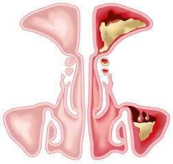 Healthy sinus and sinusitis, medical illustration