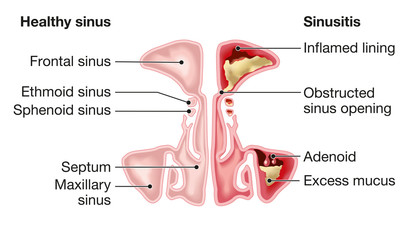 Healthy sinus and sinusitis, medical illustration, labeled