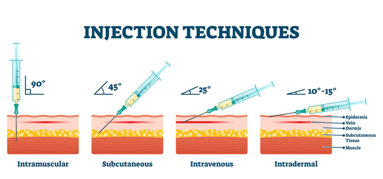 Injection techniques vector illustration. Medical procedure examples scheme