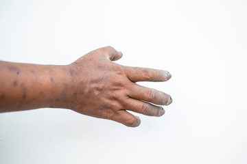 Dirty hands and fingers and skin are black spots.