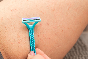 Foliculitis on hairy skin - shaving