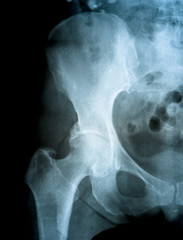 X-ray of the pelvis and spinal column of a woman