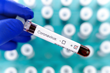 Obraz premium Health worker holds one test-tube indicating positive results of corona virus test. Many blood tube-tests as a background.