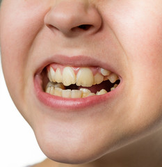 Bad crooked teeth of young girl.