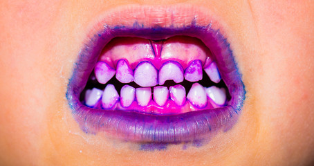 Plaque on teeth colored pink and purple.