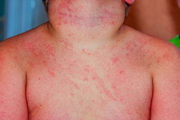 Fototapeta premium A child with severe heat rash on his neck and chest coused by warm and humid summer.