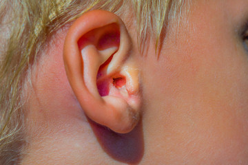 A little child with ear infection. From infected outer auditoy canal slime is slowely comming out...