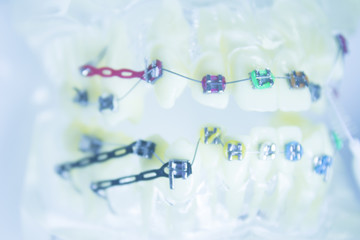 Model denture with metal orthodontics