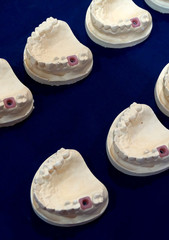 Closeup of dentures in the process of making false teeth