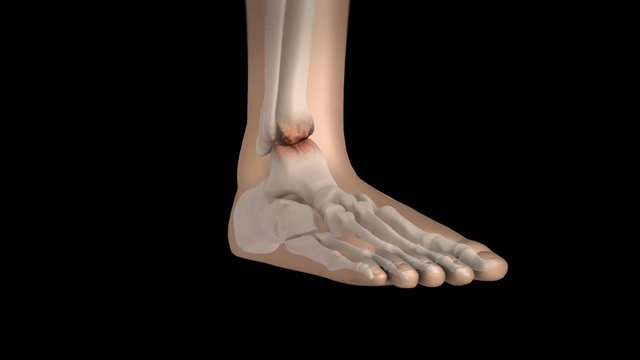 Biomedical animation showing ankle fusion.