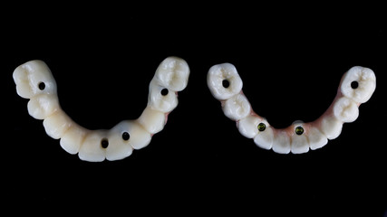 high-quality dental prostheses for the lower and upper jaw top view, shot on black glass with reflection
