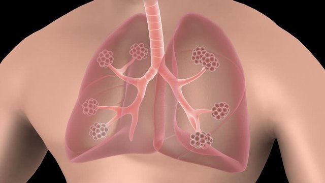 Biomedical animation of emphysema in the human lungs.