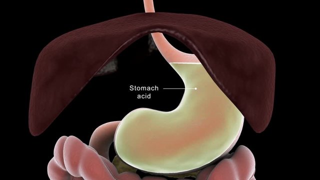 Biomedical animation of a hiatal hernia in the human stomach causing GERD.