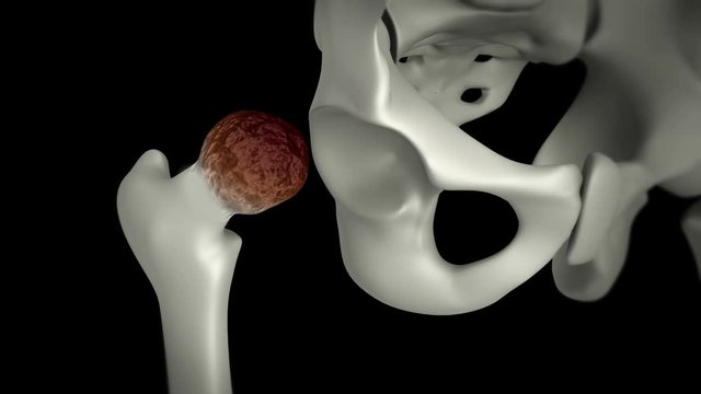 Biomedical animation of a hip replacement.