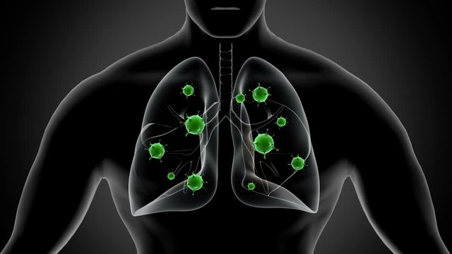 Biomedical animation of pneumonia infected lungs.