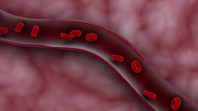 Biomedical animation of an ischemic stroke in the brain.