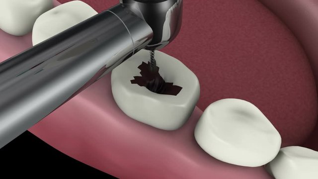Biomedical animation of a root canal treatment.
