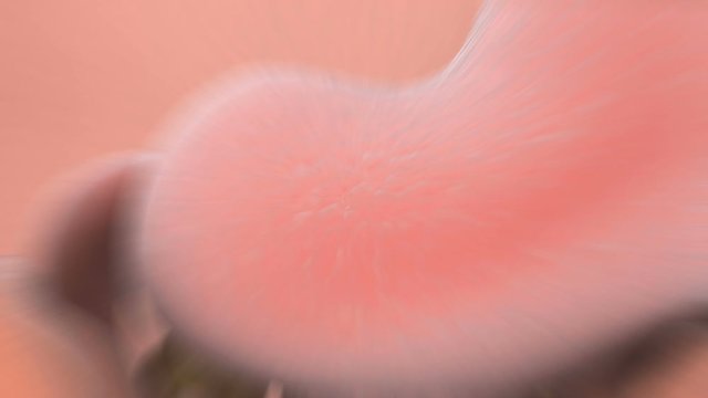 Biomedical animation of a stomach ulcer.