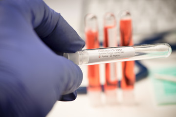Blood test for COVID-19. Examination of a blood sample for the presence of SARS-CoV-2 coronavirus
