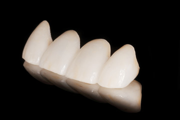 Zahnkrone Veneer aus Vollkeramik