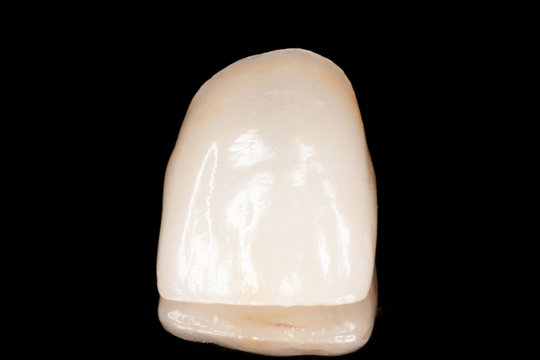 Zahnkrone Veneer aus Vollkeramik