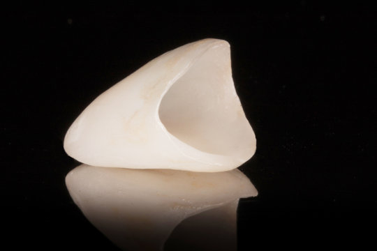 Zahnkrone Veneer aus Vollkeramik