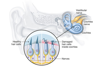 Tinnitus, healthy and damaged hair cells inside cochlea, medical illustration © Axel Kock