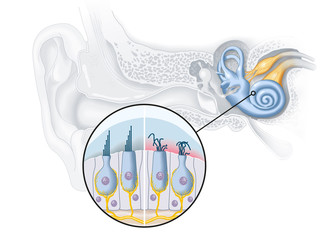 Tinnitus, healthy and damaged hair cells inside cochlea, medical illustration - obrazy, fototapety, plakaty