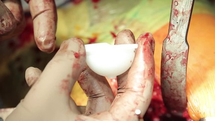 Surgeon demonstrate a polyethylene liner of acetabular cup close-up during the surgery of hip replacement  