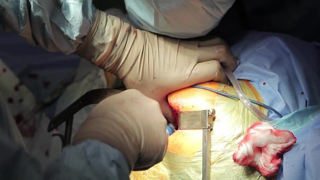 Surgeon pushes the ceramic head of hip implant during the surgery close-up  
