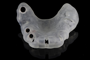 surgical template for implantation of three dental implants in the chewing portion