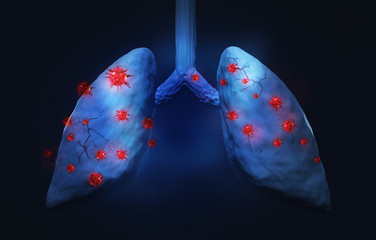 Lunge Virus Lungenkrankheit