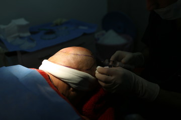 9 January 2014 Istanbul, Turkey. Hair transplantation is a surgical technique that moves hair...