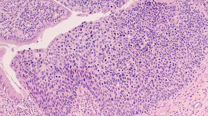 Severe Dysplasia (CIN IiI,  HSIL), related to human papilloma virus (HPV), can lead to  squamous...