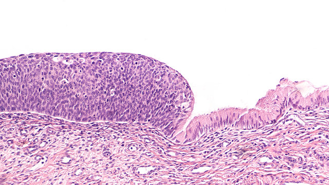Severe Dysplasia (CIN IiI,  HSIL), related to human papilloma virus (HPV), can lead to  squamous cell carcinoma (cancer) of the uterine cervix.  Vaccine is now available.
