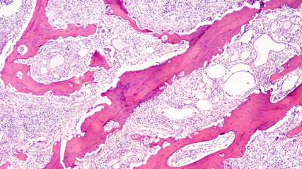 Fototapeta na wymiar Diabetes Awareness: Photomicrograph showing osteomyelitis, with necrotic (dead) bone and inflammation, from amputation of big toe of a patient with uncontrolled diabetes mellitus. 
