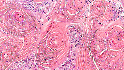 Microscopic image of skin biopsy of invasive squamous cell carcinoma, well differentiated, with...