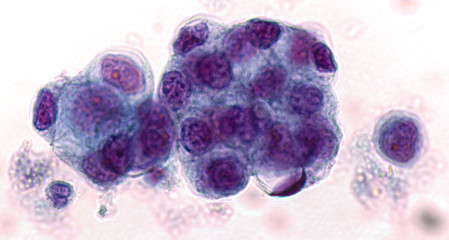 Malignant fluid cytology;   Malignant cells of adenocarcinoma may spread to fluid of  pleural or...