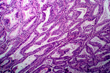 Endometrial adenocarcinoma, light micrograph