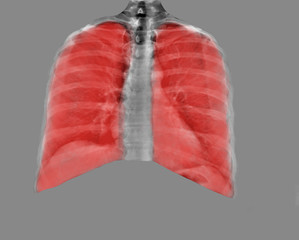 lungs on x-ray ,coronavirus pneumonia, pulmonology